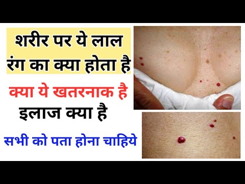 शरीर पर ये लाल रंग का क्या होता हैं - क्या ये dangerous है - इसका इलाज क्या है