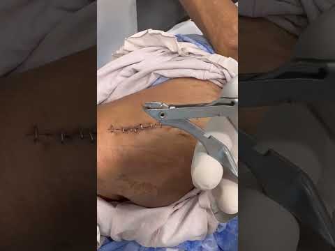 ऑपरेशन के बाद टाँके कैसे निकलते हैं ? Stitch/staple removal after surgery  #shortsindia