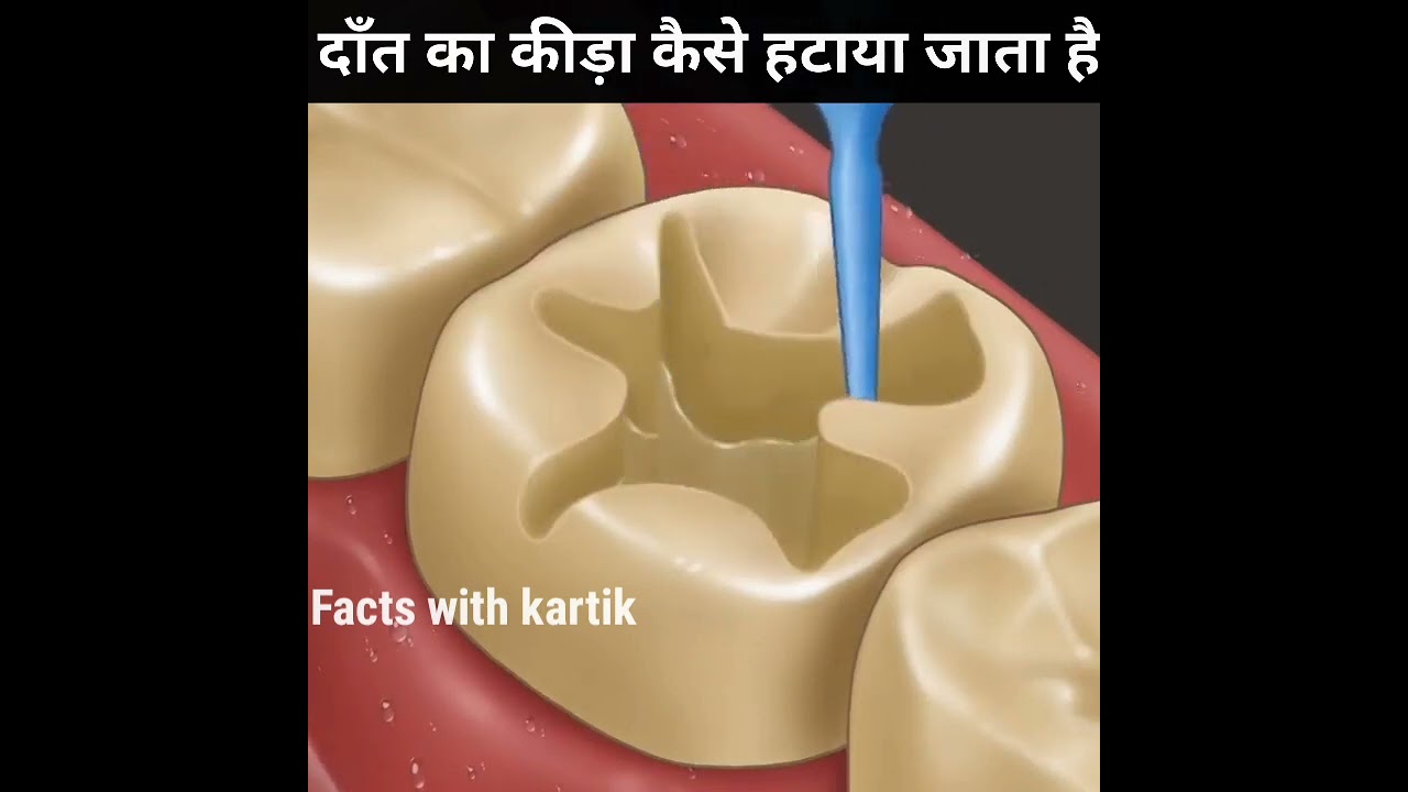 🦷दाँत का कीड़ा कैसे हटाते हैं👨‍⚕ by Animation #shorts #shortvideo