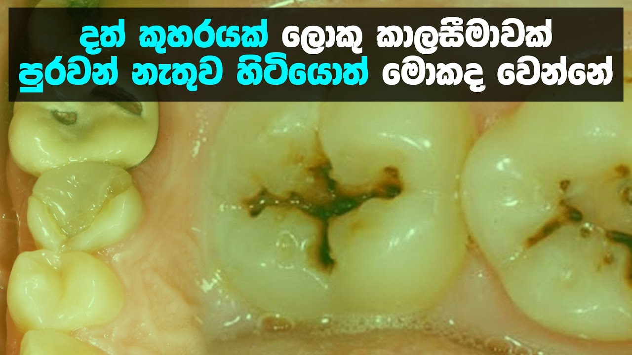 දත් කුහරයක් ලොකු කාලසීමාවක් පුරවන් නැතුව හිටියොත් මොකද වෙන්නේ