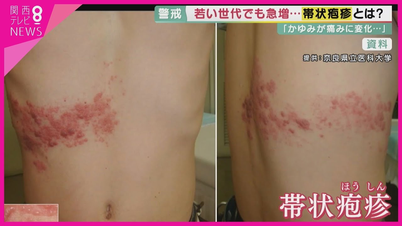 「かゆみが痛みに…」若い世代でも患者急増の「帯状疱疹」気づきにくく治療が遅れ重症化するケースも　“免疫機能”を高めることが予防のポイント【報道ランナー】