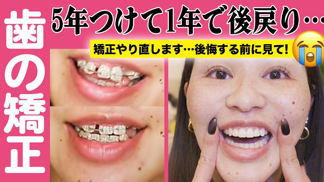 【矯正完成後】もう後戻りしてんけど😭！矯正やり直します…！経過報告