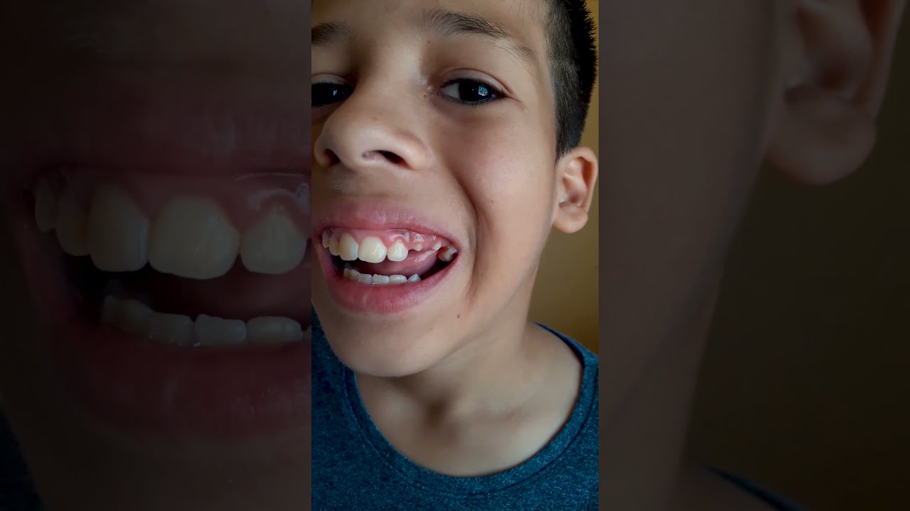 🦷 Olliver Arrancou Dente na Unha