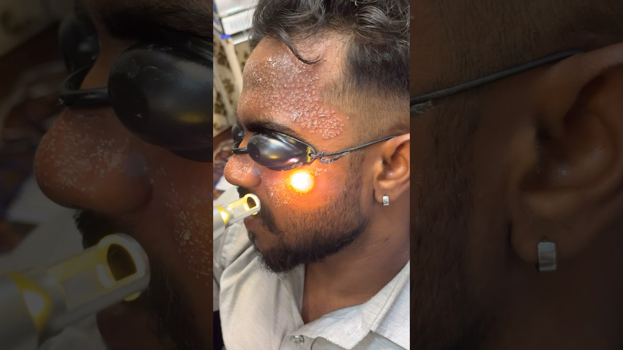 # skin whitening laser treatment # spots treatment #permanent #glowingskin #laser #shrots 9910549389