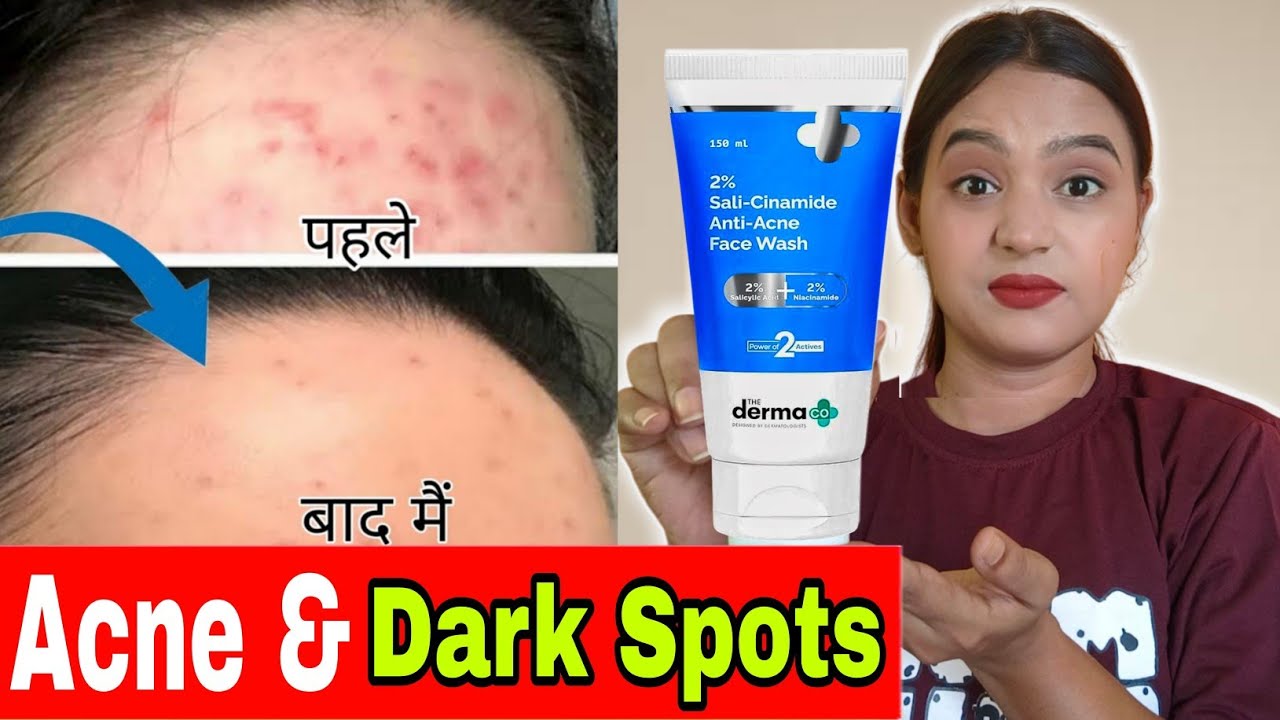 😳 The Derma Co 2% Sali Cinamide Anti Acne Face Wash review sali cinamide derma co face wash