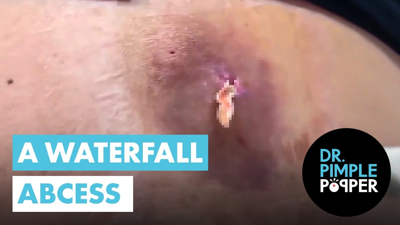 A Waterfall Abcess