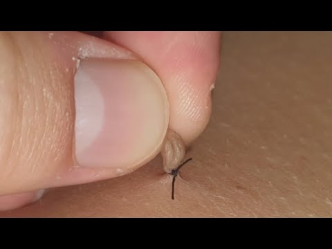 ACROCORDONES. Cómo quitarlos