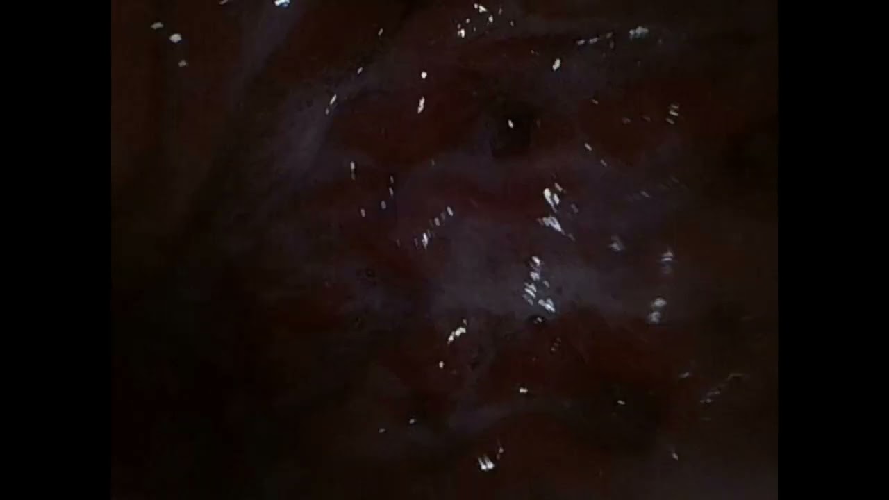 asian girl swallows endoscope
