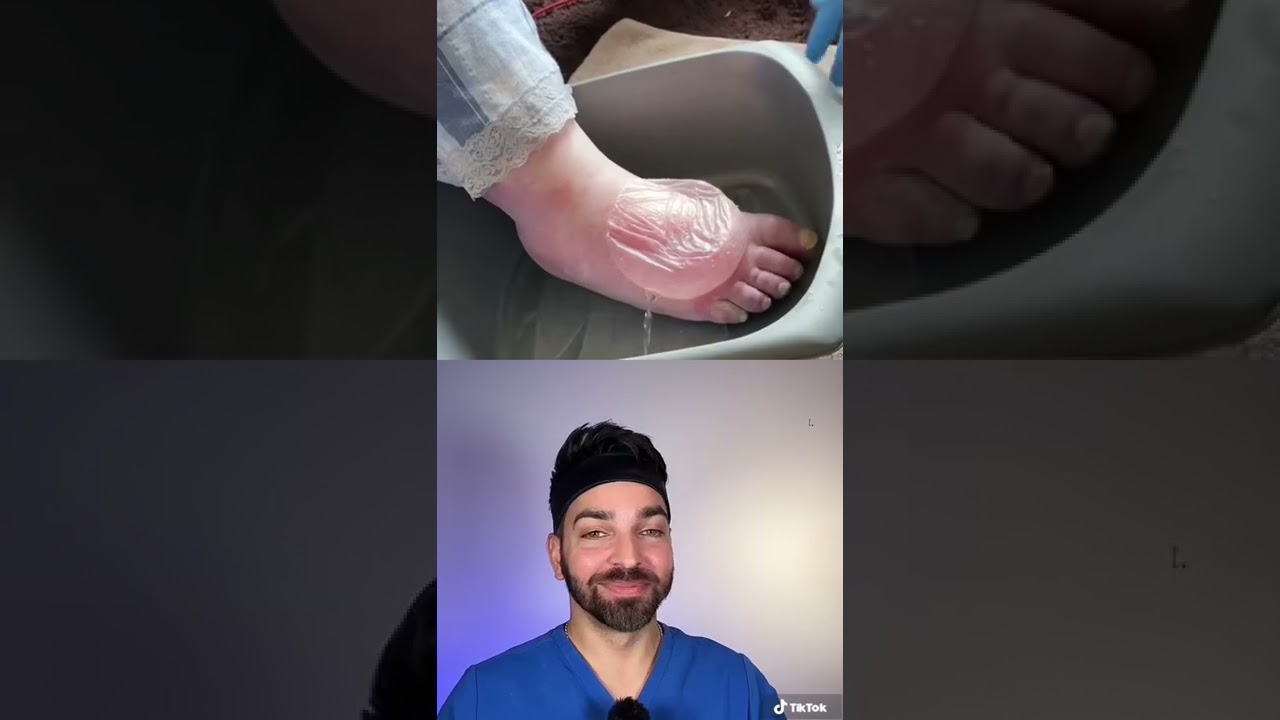 BIGGEST Blister I’ve Seen | Doctorly #shorts