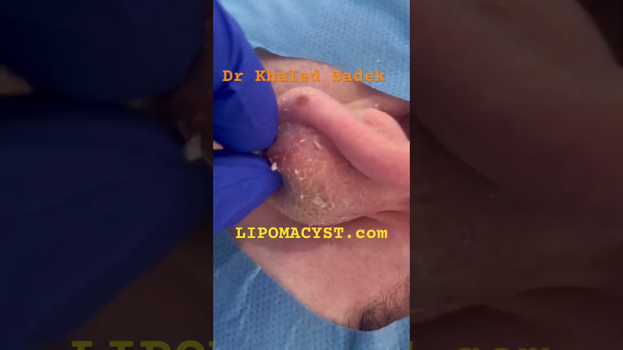 Biggest ear cyst Ever! #skincare #blackheadremoval Dr Khaled