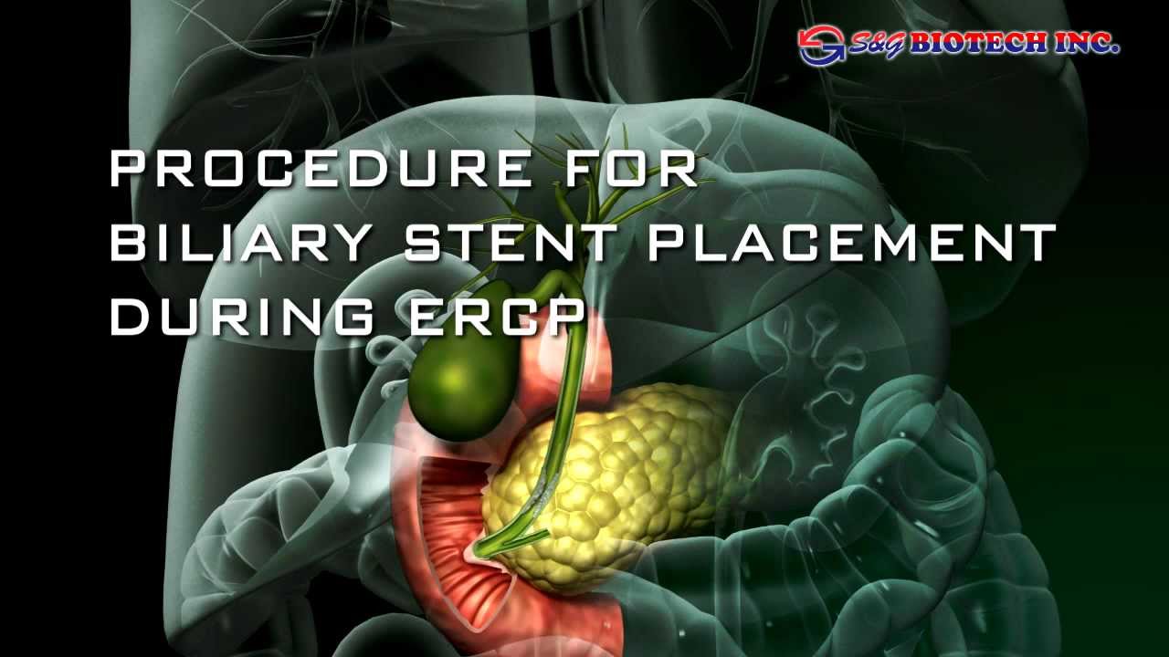 Biliary Stent