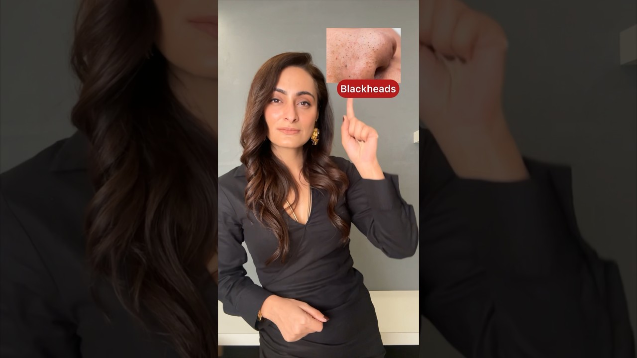 Blackheads, whiteheads, acne dark spots, open pores | dermatologist suggests