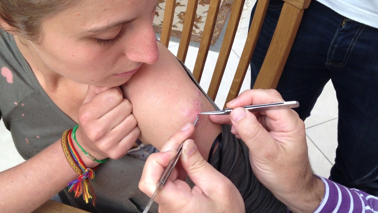 Botfly Maggot Removal