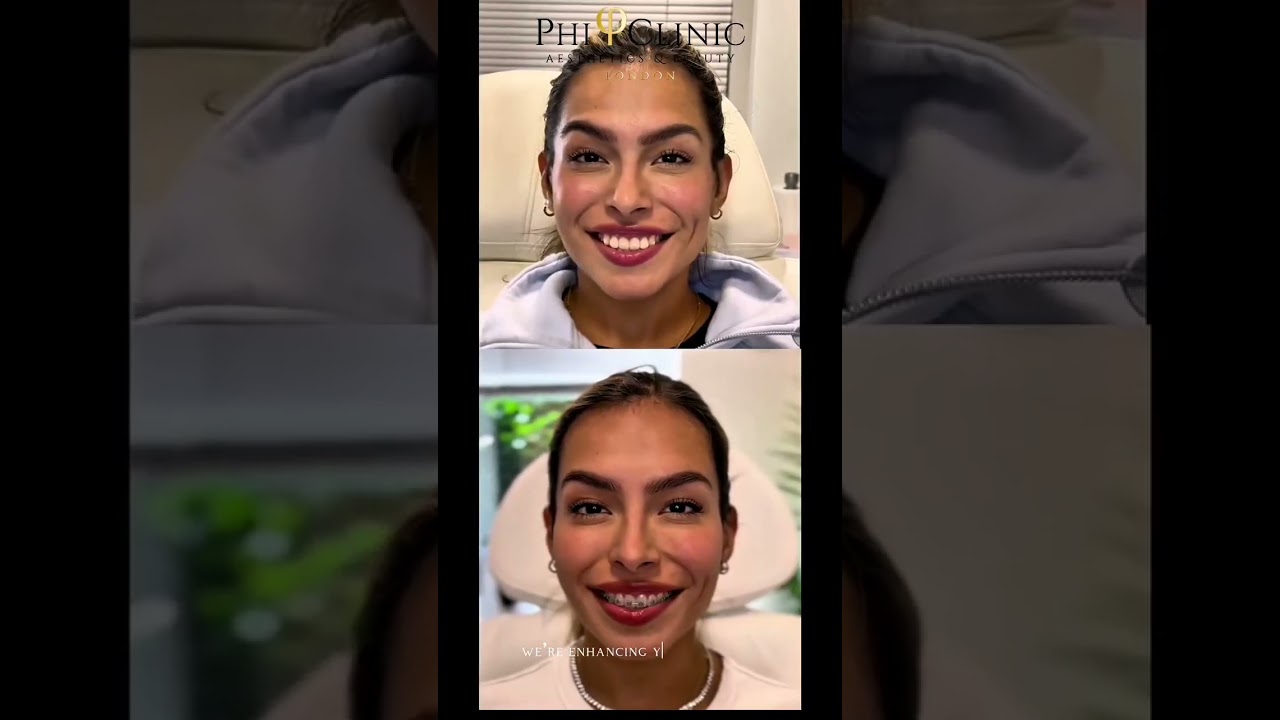 Botox Treatment
