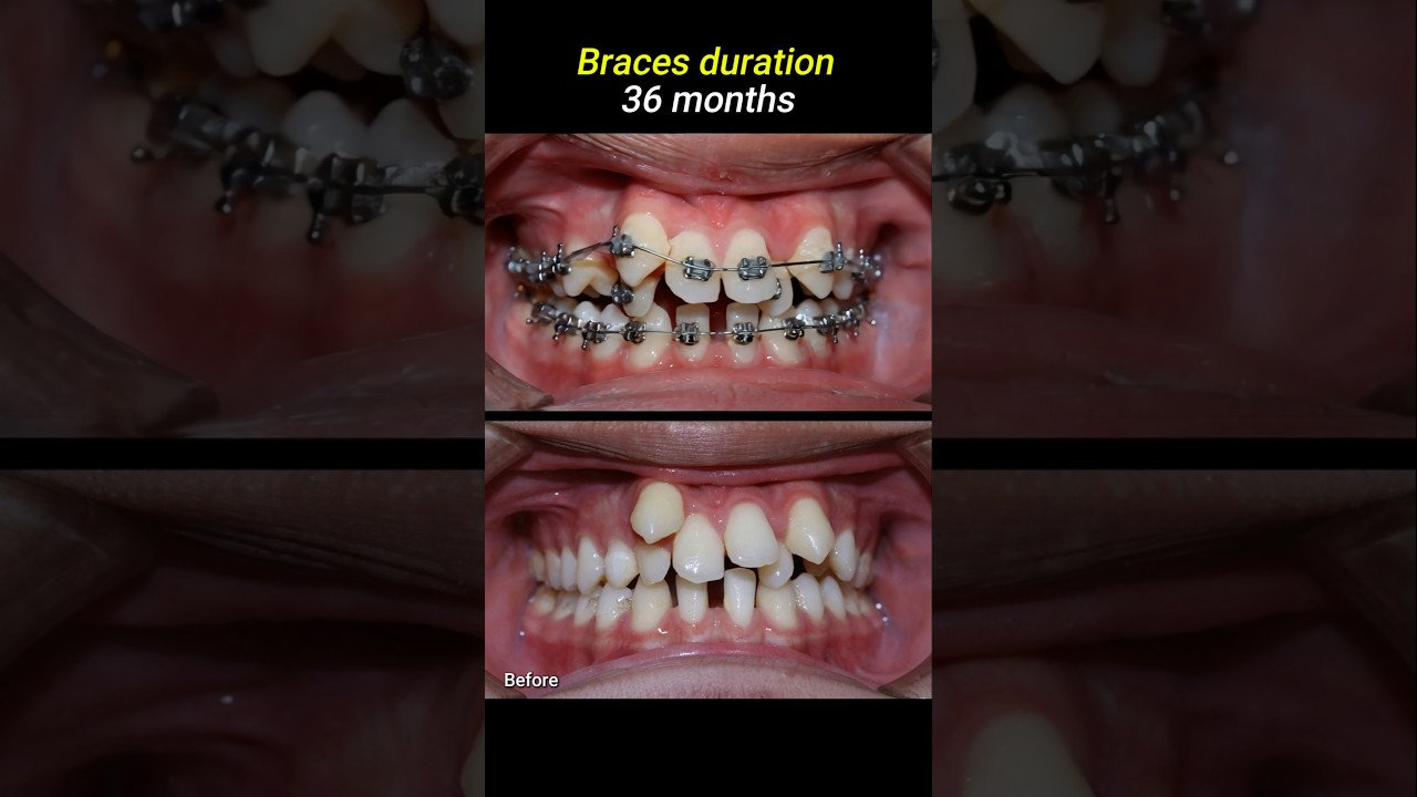 Braces for crowded teeth #braces #orthodontist #dentistry #dentist