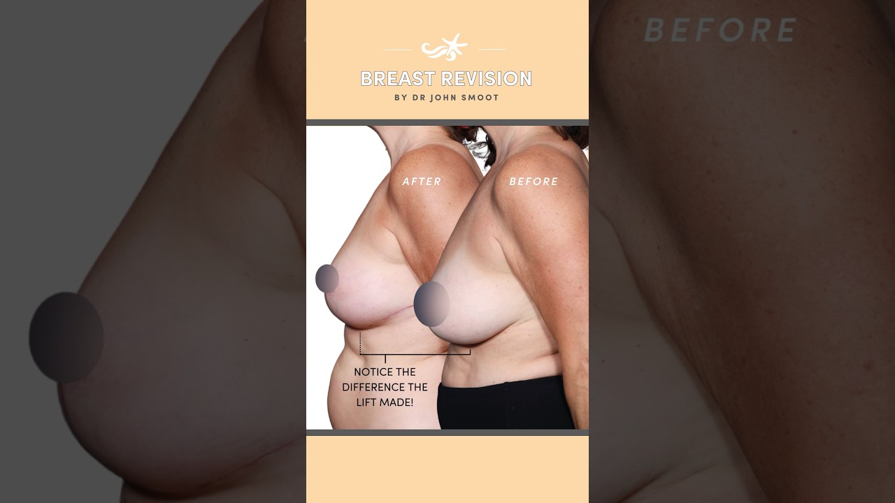 Breast revision restored this patient’s original breast aug results 🙏❤️