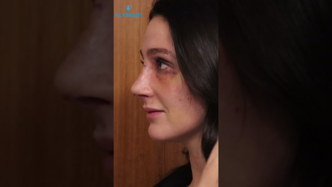 BRIANA YOU LOOK AWESOME 👏🏼🔥😍 #flymedi #healthtourism #rhinoplastybeforeandafter #medicaltourism