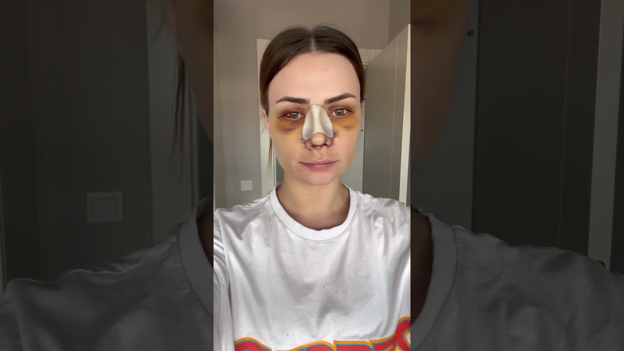 Burun ameliyatı olmak isteyenleri görelim 😃😃😃