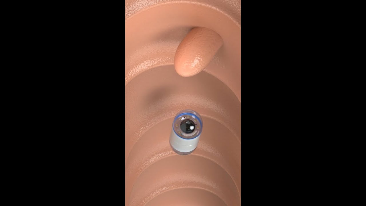 Capsule Endoscopy #science #shorts #medicine