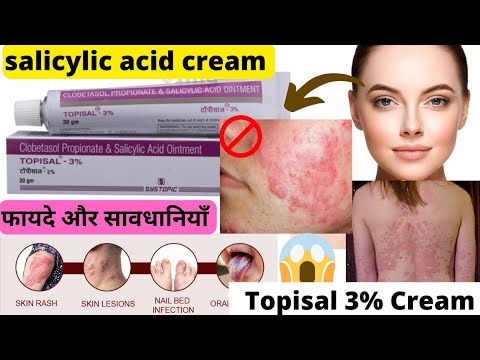 Clobetasol propionate and salicylic acid ointment|Topisal 3 cream |Salicylic acid cream|Acne