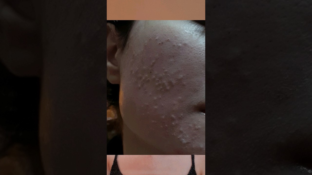 Comedonal acne treatment with pharmacy gel Adorg B💮 before and after #skincare #viral #shorts