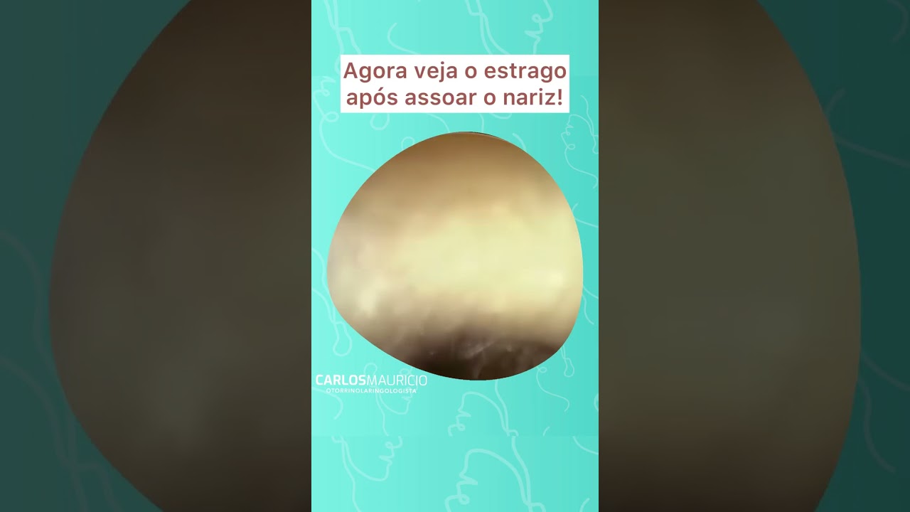 Cuidado ao assoar o nariz!