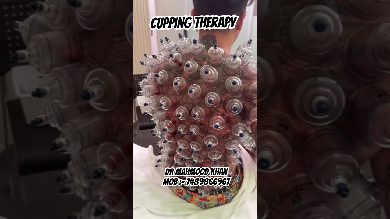 Cupping Therapy #cupping #cuppingtherapy #hijama #hijamatherapy #hijamaguy