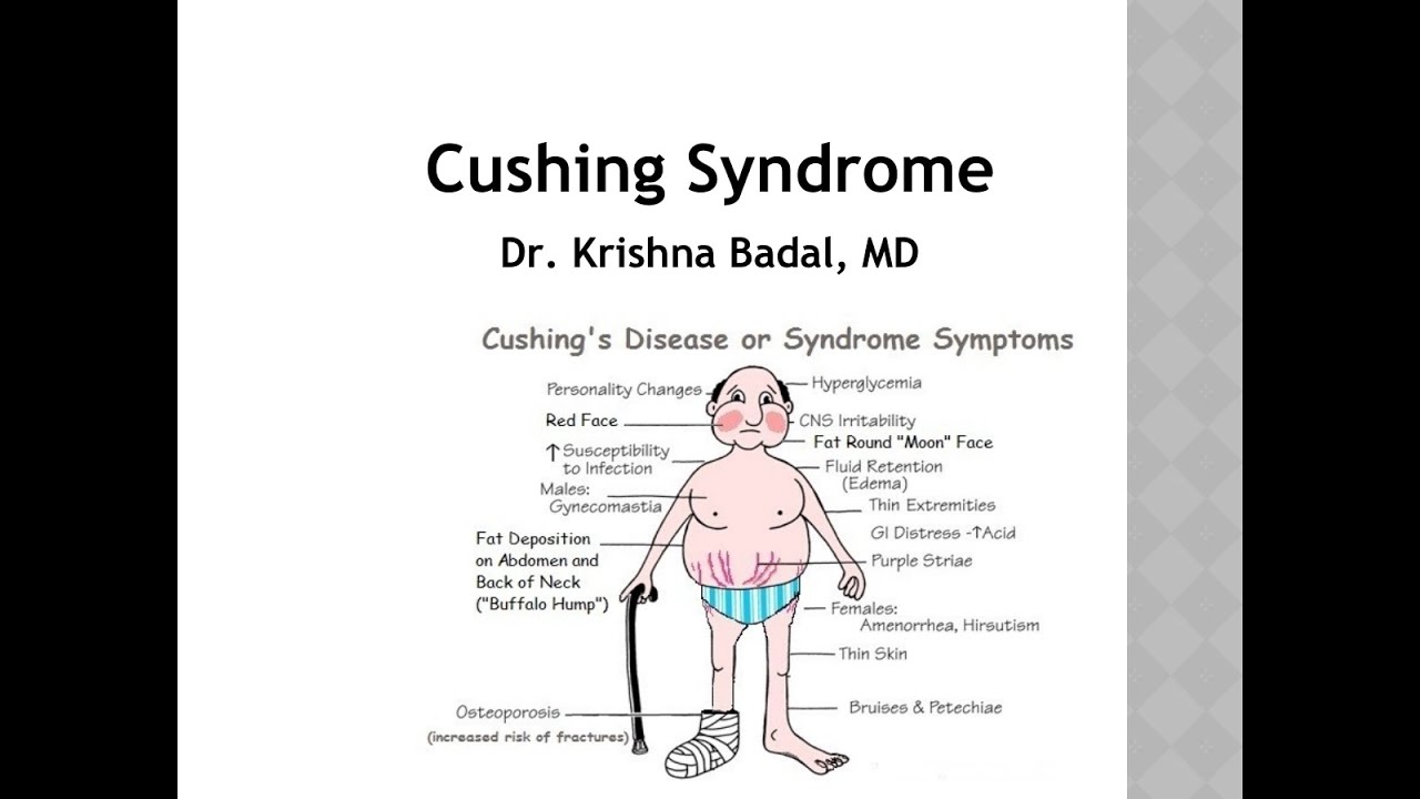 Cushing syndrome