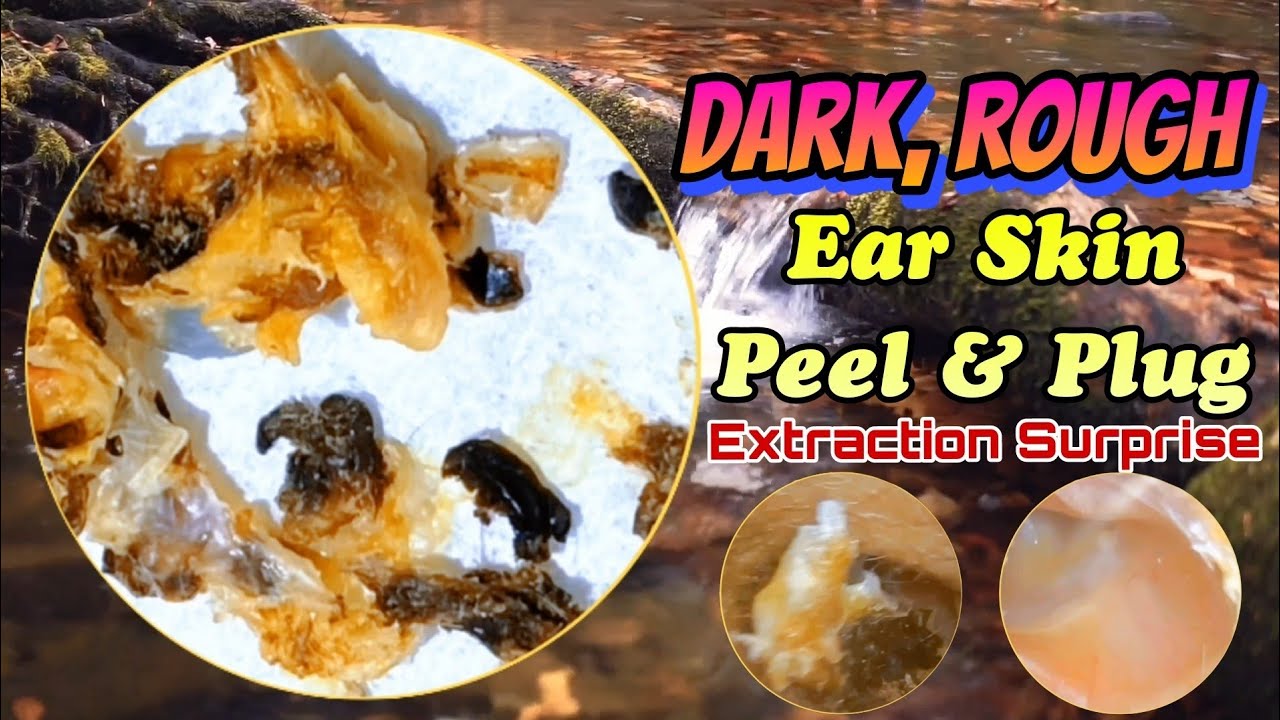 Dark, Rough Ear Skin Peel & Plug Extraction Surprise