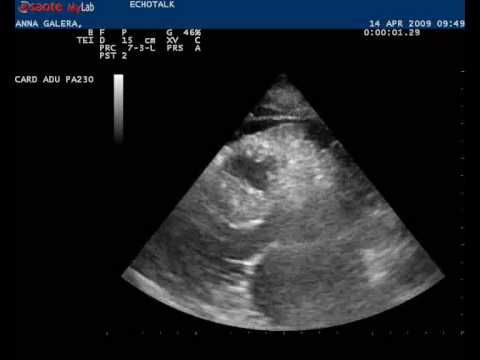DERRAME RENAL