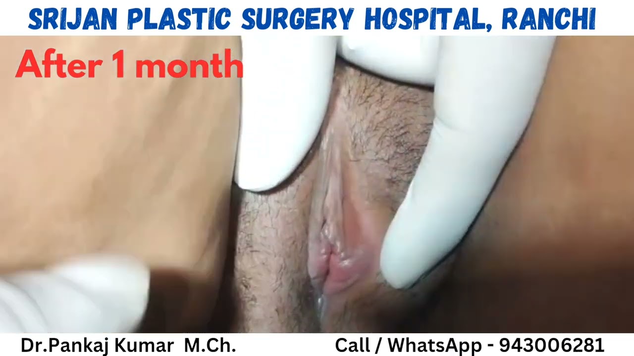 Designer vegina - Genital cosmetic surgery| Labiaplasty & Hymenoplasty Surgery in Ranchi