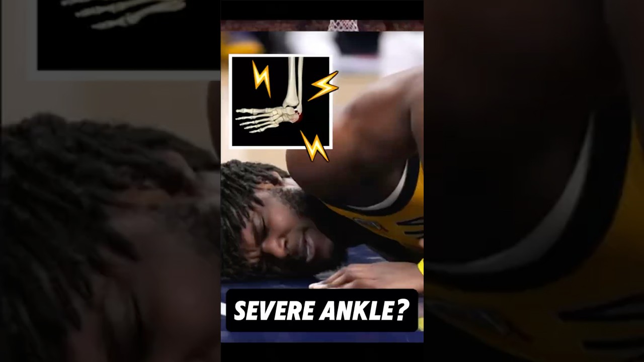 Doctor explains Jarace Walker’s severe ankle injury #pacers #nbaplayoffs #medical #science #anatomy