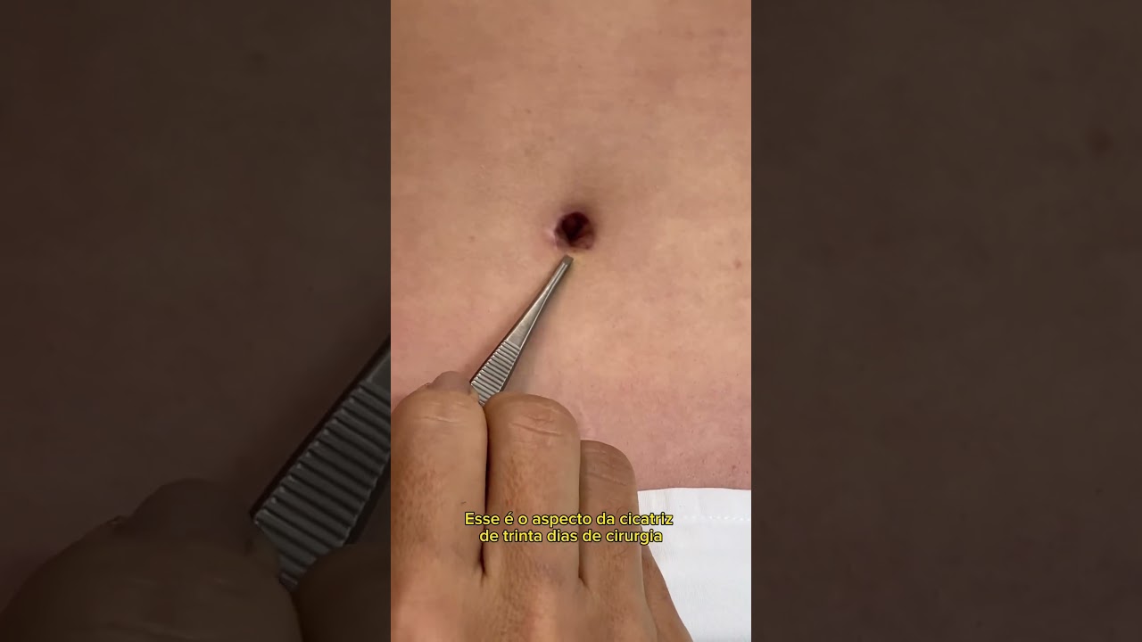 “Dra. Luciana, como fica o umbigo depois da abdominoplastia?”