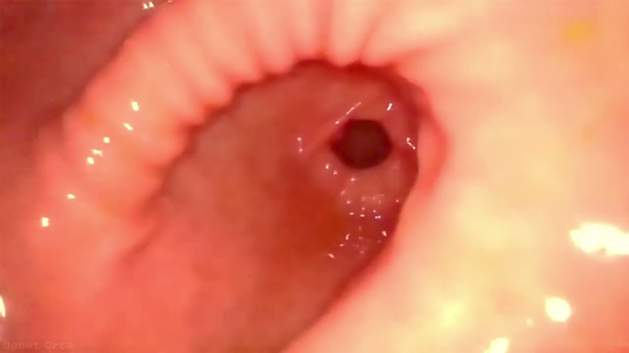 Endoscope 010 Lots of berries 🫐