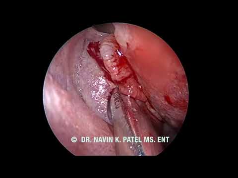 ENDOSCOPIC SINUS SURGERY