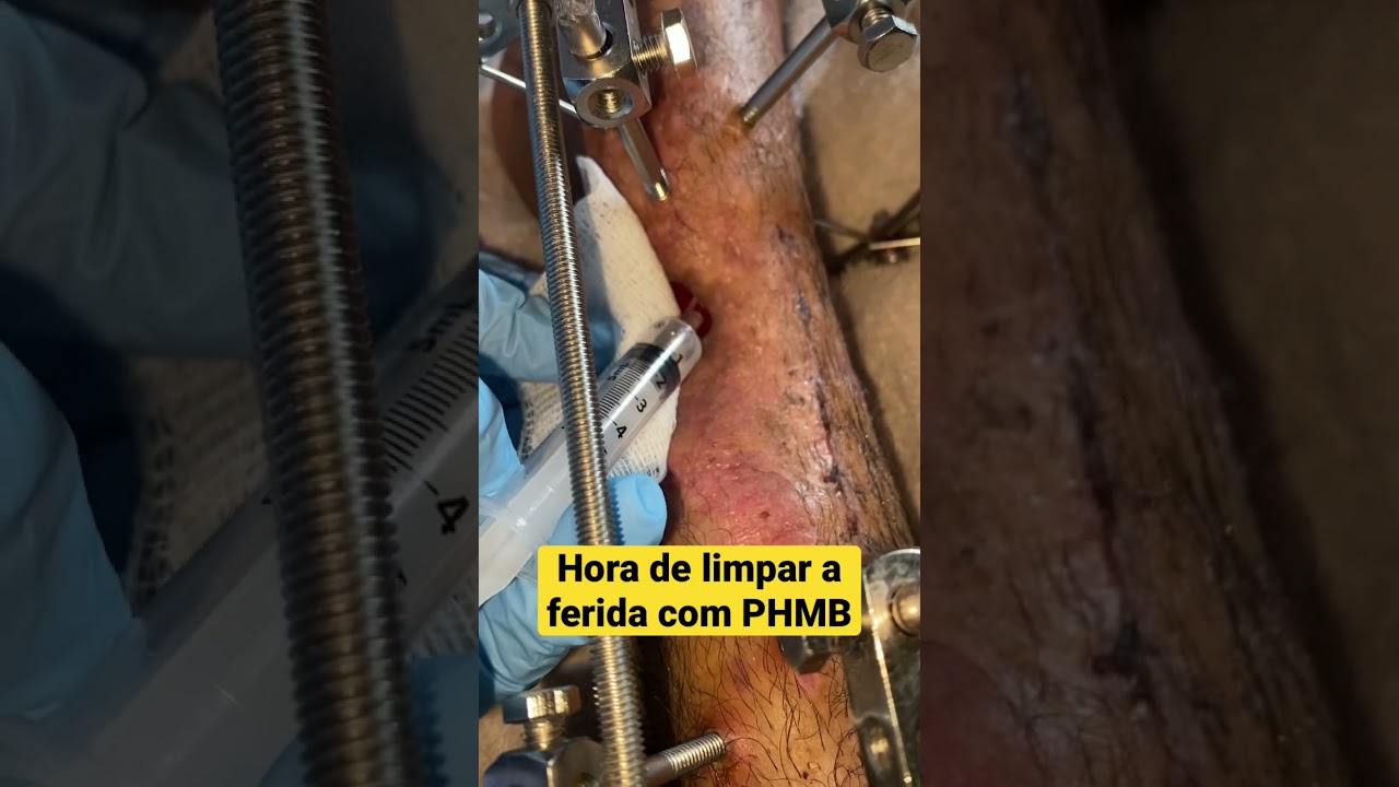 #enfermagem #tratamentodeferidas #ciência #PHMB #moto #acidente #cuidados #limpeza #curiosidades