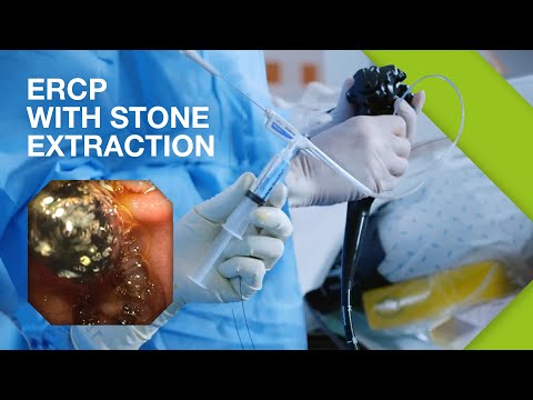 ERCP Practical Guide I Part 2: ERCP with Stone Extraction
