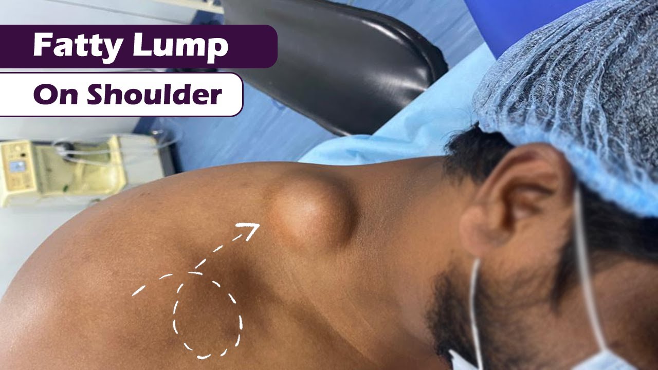 Fatty Lump on Shoulder | Lipoma Removal