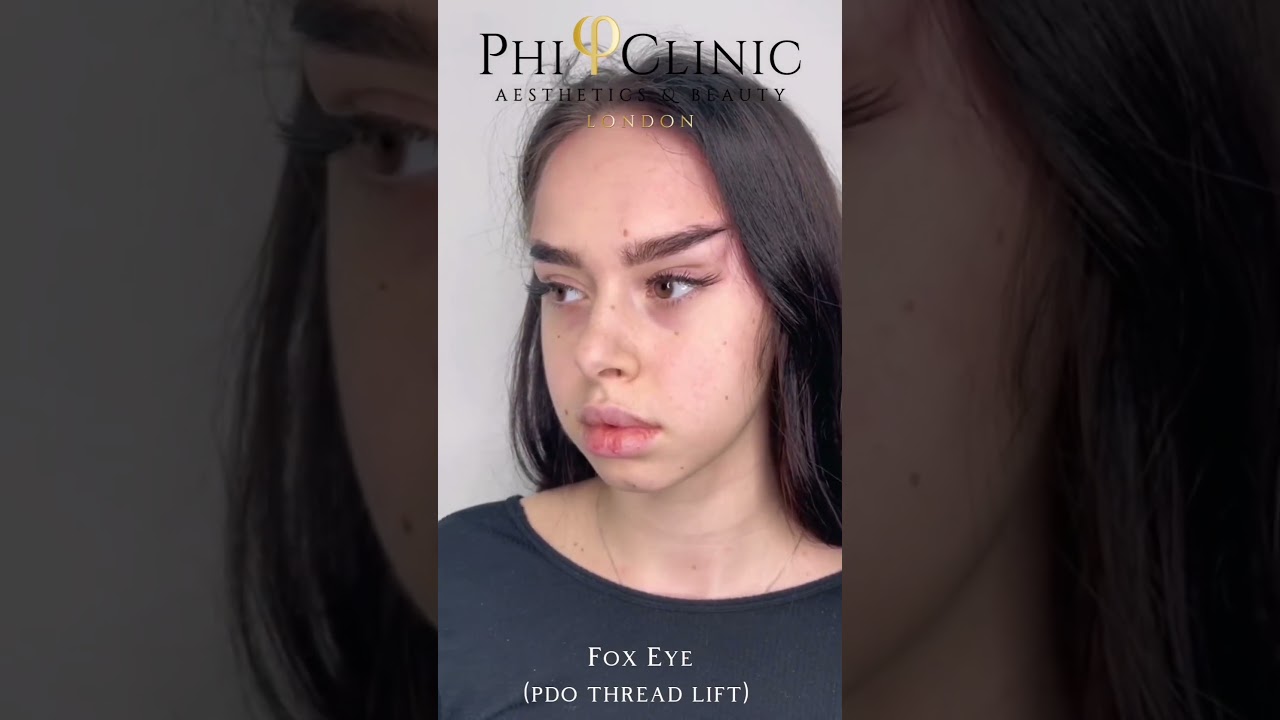 Fox Eye (PDO Threads Lift)