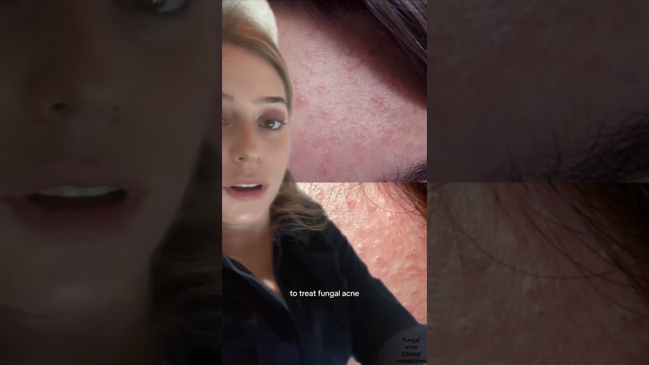 Fungal Acne vs. Closed Comedones Part 2 #shorts