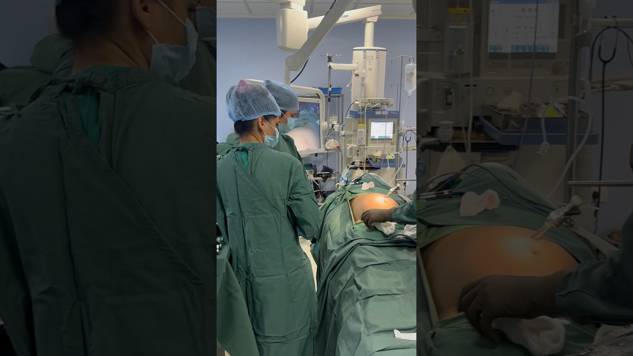 Gallstones Removal Treatment is Cholecystectomy Surgery I Surat I Gujarat I India