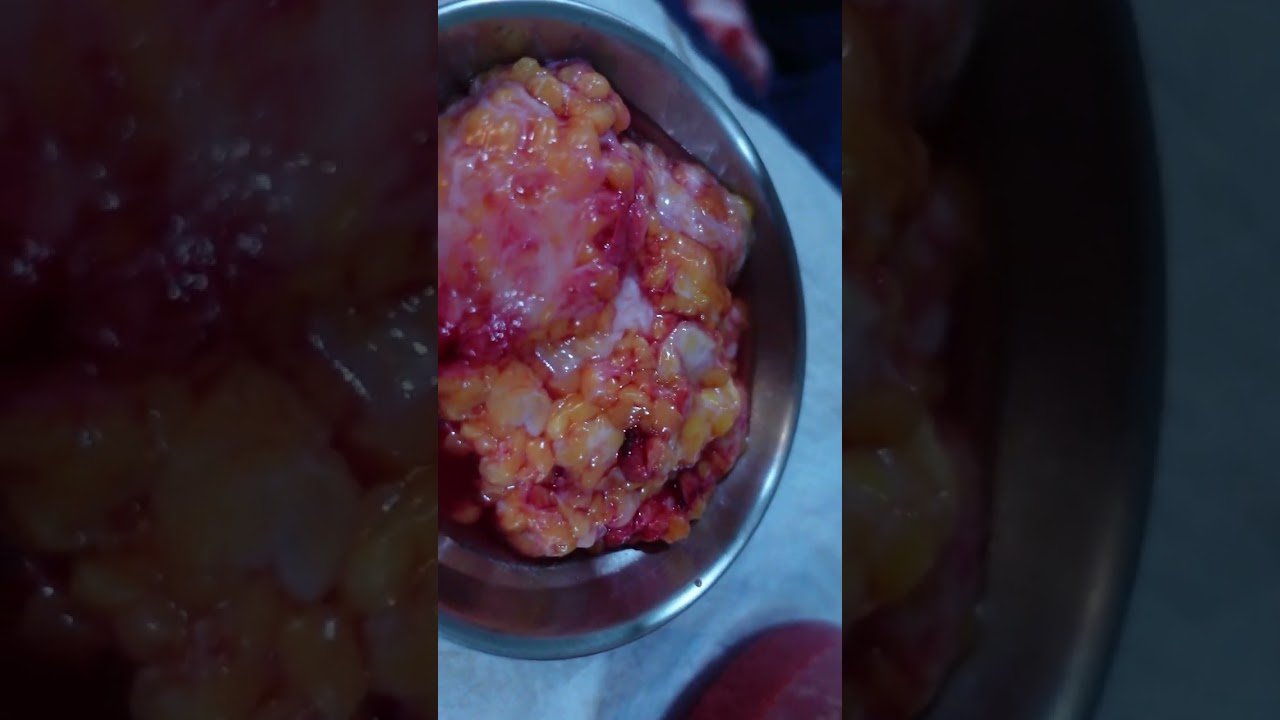 Gynecomastia Surgery | Cure of Gynecomastia Surgery | Manboobs Surgery result #youtubeshorts
