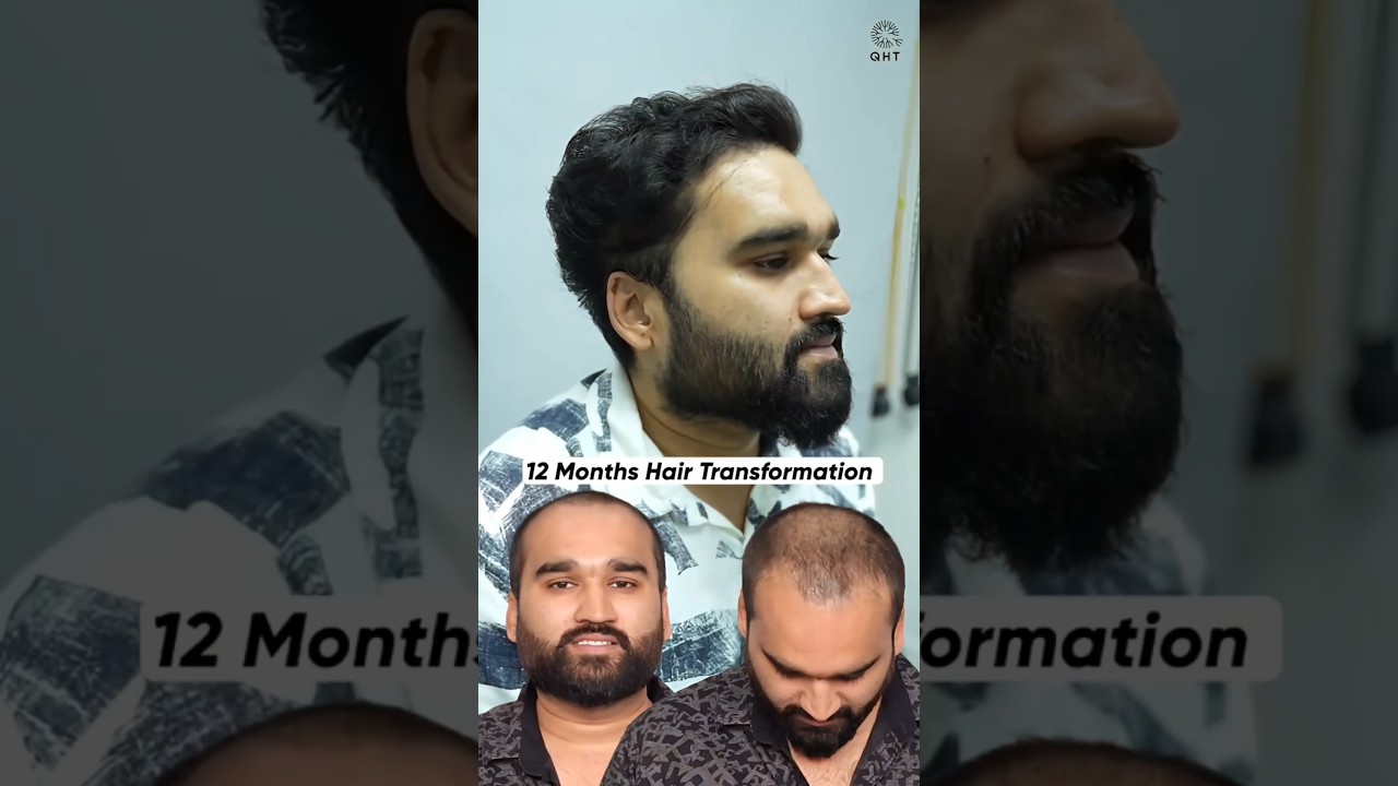 Hair Transplant Before After | #qht #shortsvideo #hairtransplant #ytshortsindia #trending #hairloss