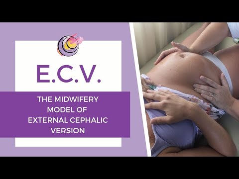 Hands On Example of The Midwifery Model Of External Cephalic Version