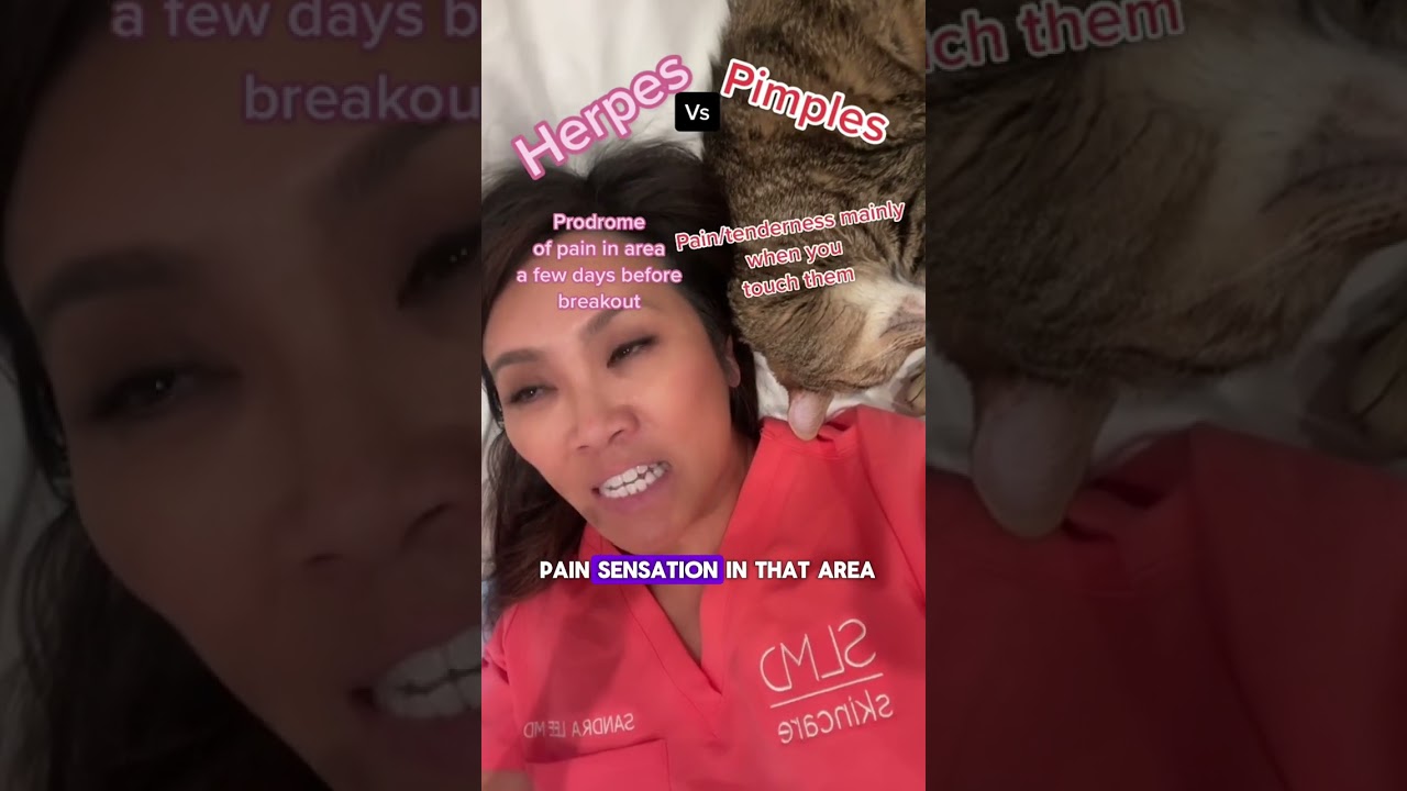 Herpes vs Pimples