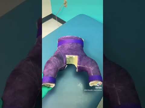Hip spica cast (Orthopedics)