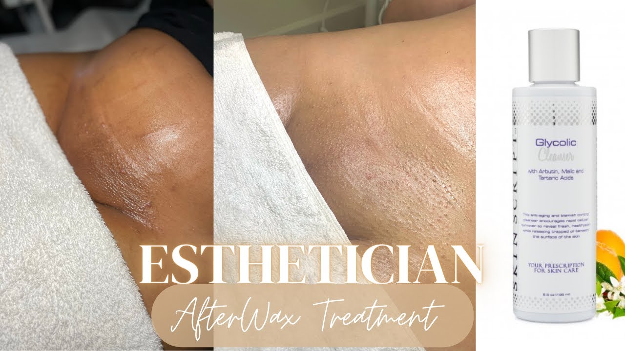 How To Treat Ingrowns & Razor Bumps | After Brazilian Wax & Vajacial Treatment| Esthetician Tips