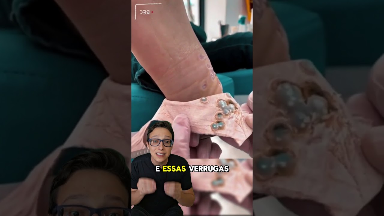 HPV 😱🦠#medicina #medico #enfermagem #curiosidades #saude #enfermeiro #dermatologia #dermatologo