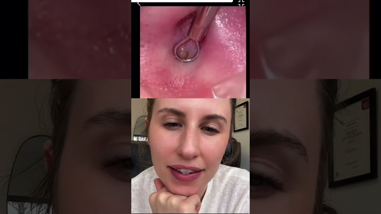 Huge Inner Ear Blackhead