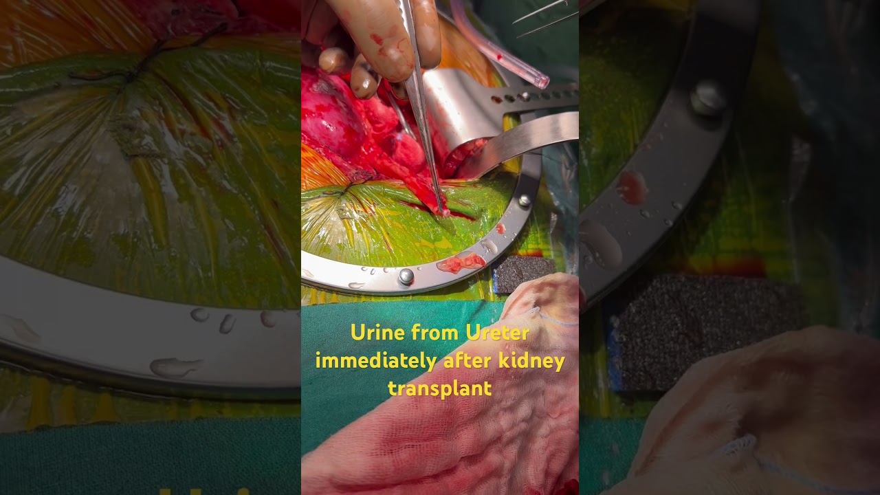 Inside operation theater - kidney transplant